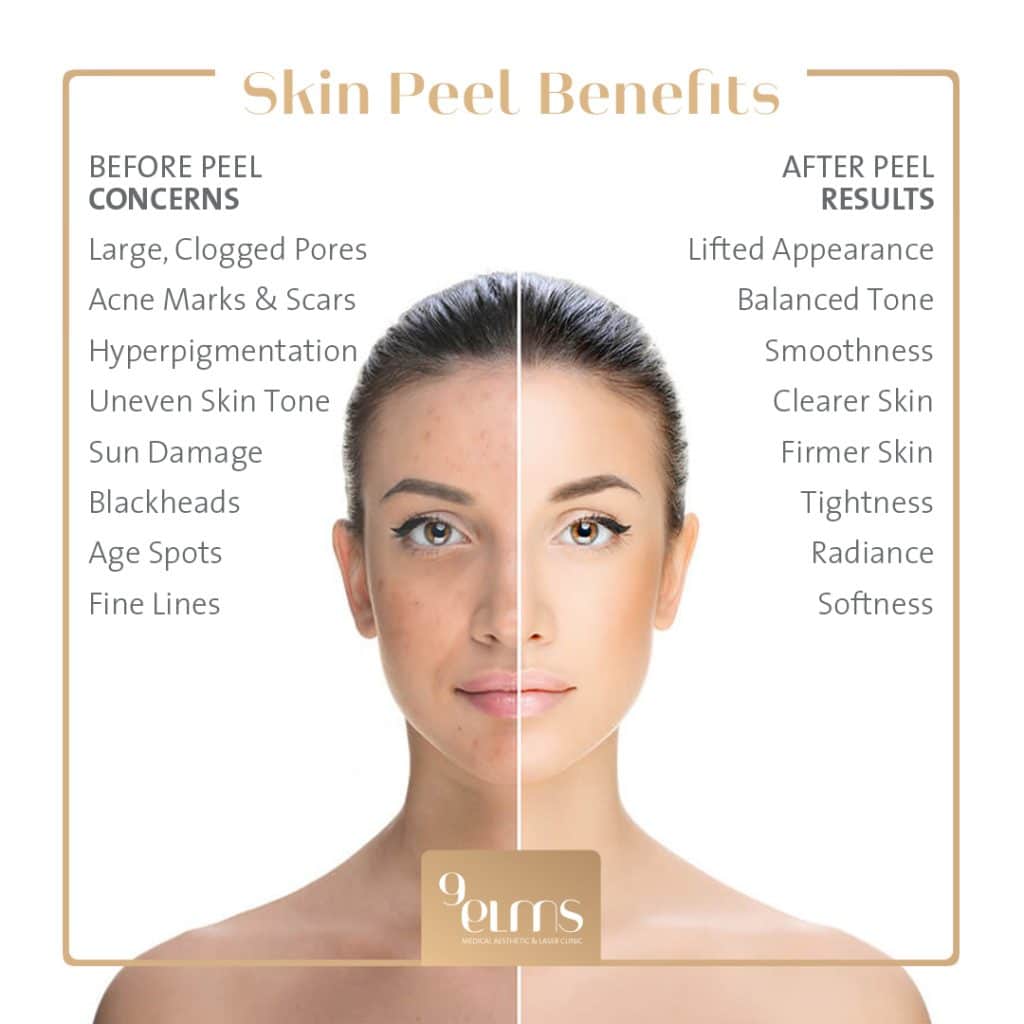 Skin Peels Nine Elms Clinic